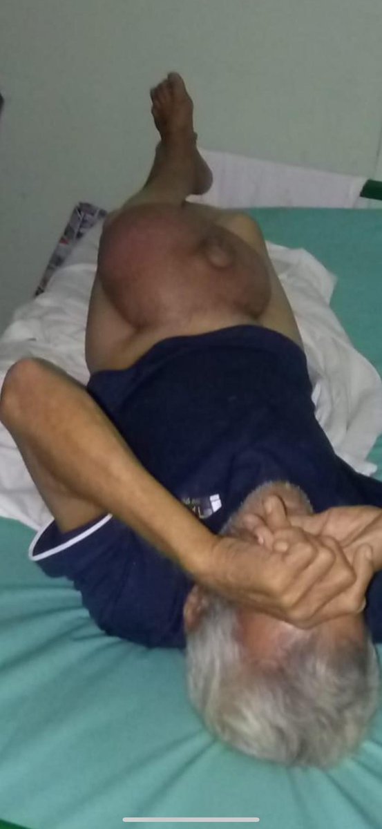 LabradaNoe2637's tweet photo. Este señor se encuentra ingresado en el Hospital Clínico Quirúrgico de Holguín y le dicen los médicos que no pueden operarlo por falta de recursos, sin embargo en los hospitales militares a los que van la cúpula castrista hay de todo ellos viven bien y el pueblo se muere. https://t.co/vt2FKlNnAk