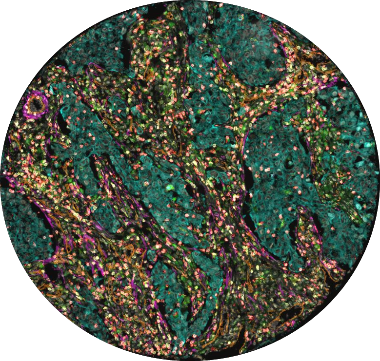 Today's #WorldCancerResearchDay! We're proud to be part of the global team working to understand and fight cancer, improving treatments and the lives of the patients. Let's keep pushing forward! #Microenviroment