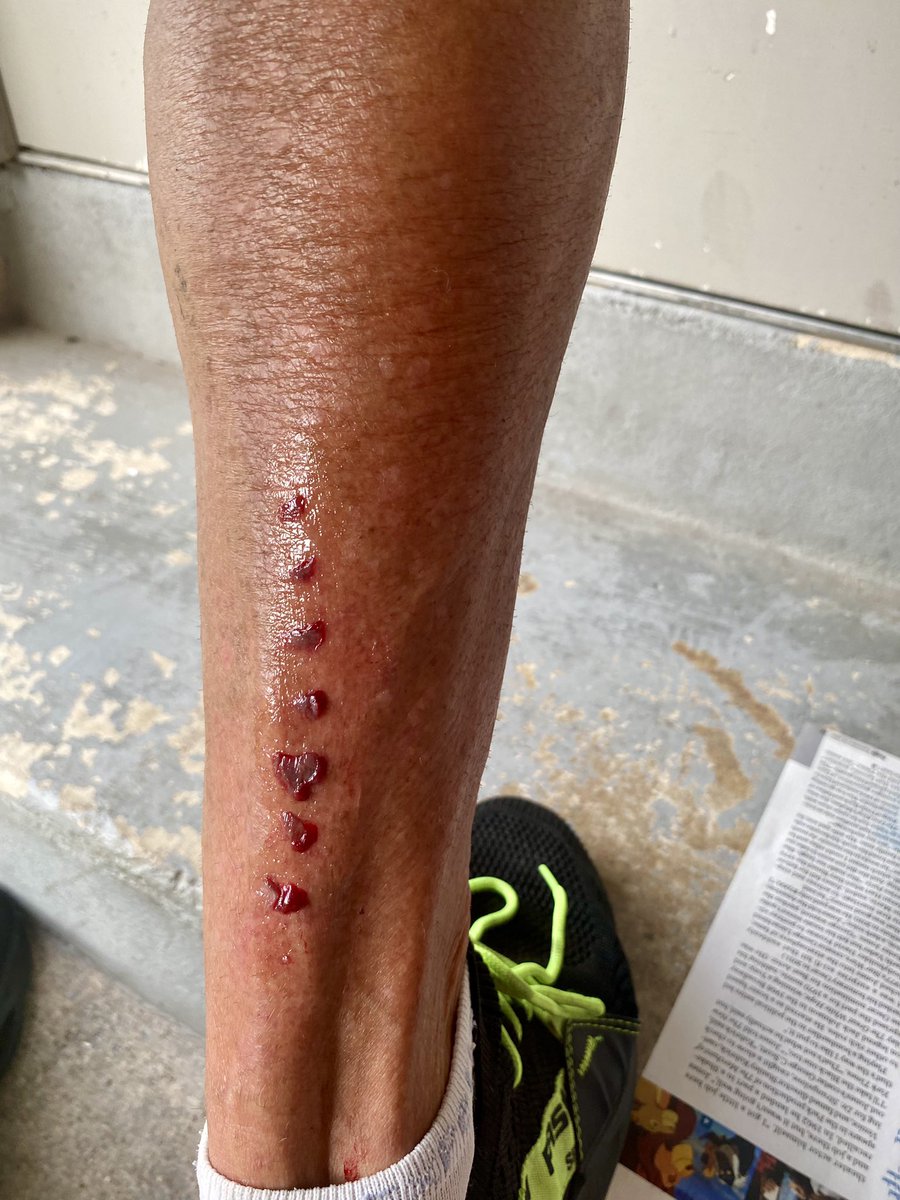 StevenRR's tweet image. 🚵‍♂️ Chain ring Tat (wife knows SO much about triple antibiotic ointment over the years) 🚴🏻‍♂️