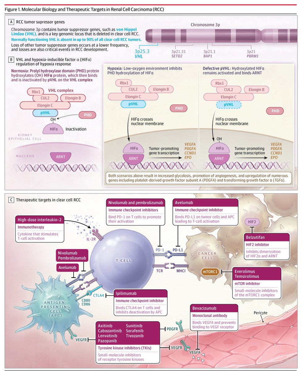 JAMAOnc's tweet image. From @JAMA_current: Renal cell carcinoma (RCC) is a common cancer, with an estimated 434 840 incident cases worldwide in 2022. This review summarizes the epidemiology, clinical presentation, pathophysiology, and management of RCC. ja.ma/4ezLtVm
