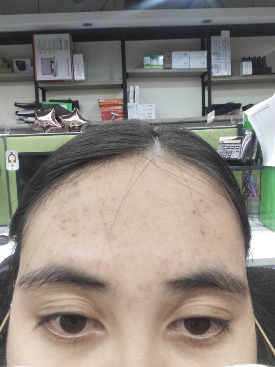 bvneyney's tweet photo. The first step to loving yourself is accepting your forehead. xoxo https://t.co/I9S9ocy80J