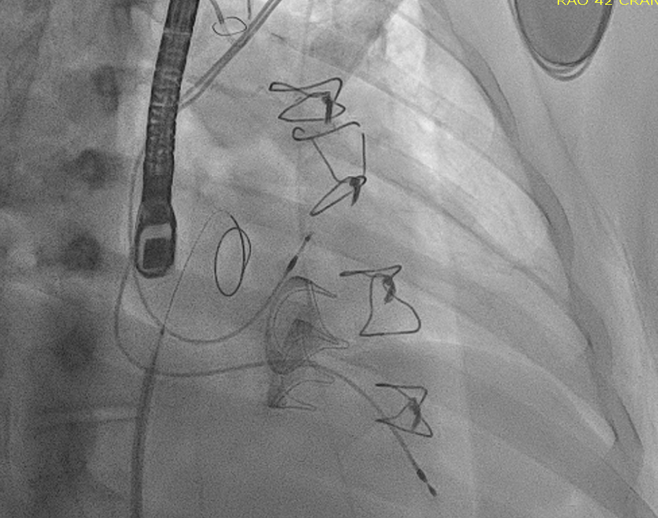CraigBasman's tweet image. 39 y/o with CP/hx IVDU/IE with prior MVR/TVR (31mm CE, PPM postop) with ADHF and severe MS/TS.  (no longer requiring PPM)

Best lifetime management strategy (young/IVDU)?

Lead extraction w/ TMTVR (+iASD closure)
@PWengrofskyMD 
@ryankaple 
@SHYoonMD 
#tavr
#CardioTwitter