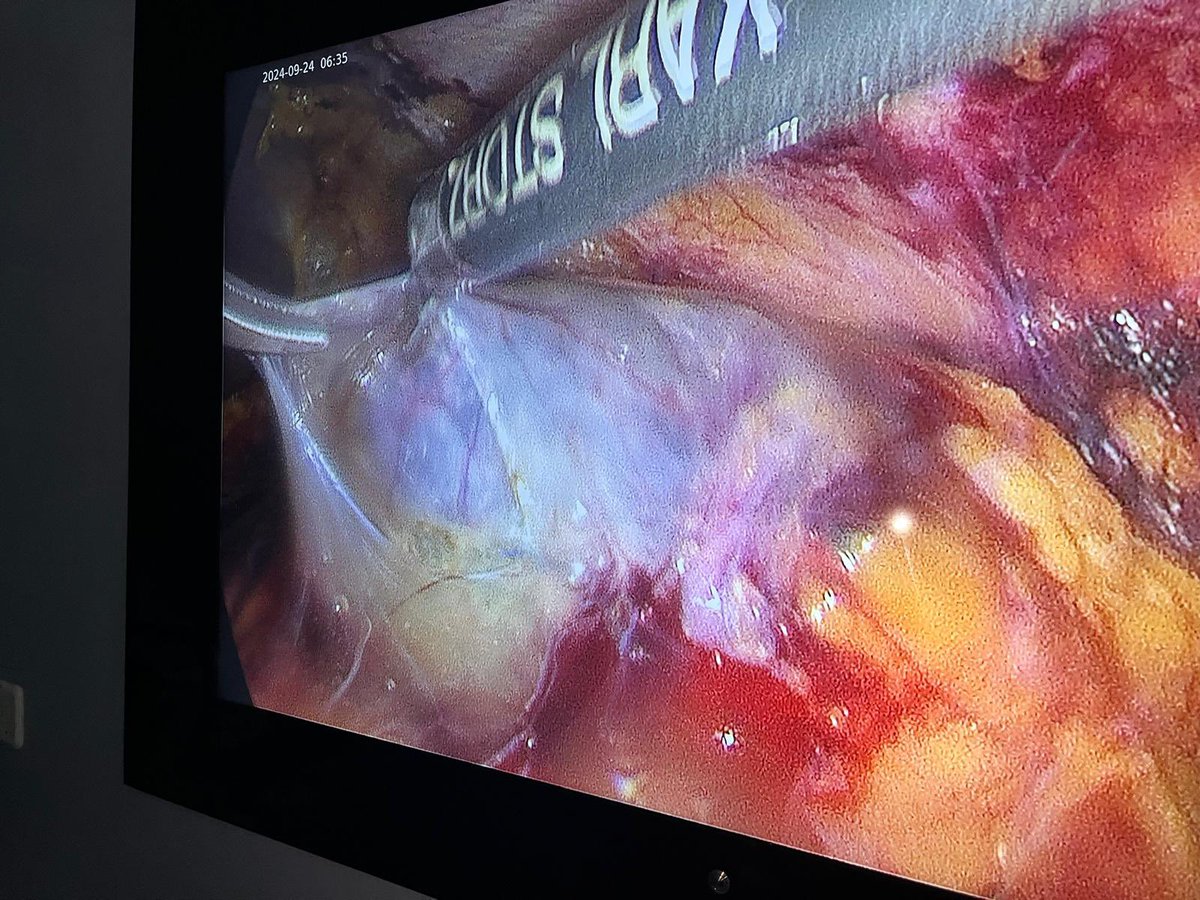 ElsieMensah (@elsiemensah4) on Twitter photo What an awesome second day of our laparoscopic urology workshop at <a href="/KBTH_GH/">Korle Bu Teaching Hospital</a> urology centre with UroLAP <a href="/mzaslam77/">Zeeshan Aslam</a> <a href="/johannboaz/">johann boaz</a> @AThwaini and <a href="/izickgh/">Ike Kweku Urologist🇬🇭</a>. Transferring skills and learning from each other ❤️. Fantastic team, great facility. What an awesome second day of our laparoscopic urology workshop at <a href="/KBTH_GH/">Korle Bu Teaching Hospital</a> urology centre with UroLAP <a href="/mzaslam77/">Zeeshan Aslam</a> <a href="/johannboaz/">johann boaz</a> @AThwaini and <a href="/izickgh/">Ike Kweku Urologist🇬🇭</a>. Transferring skills and learning from each other ❤️. Fantastic team, great facility.
