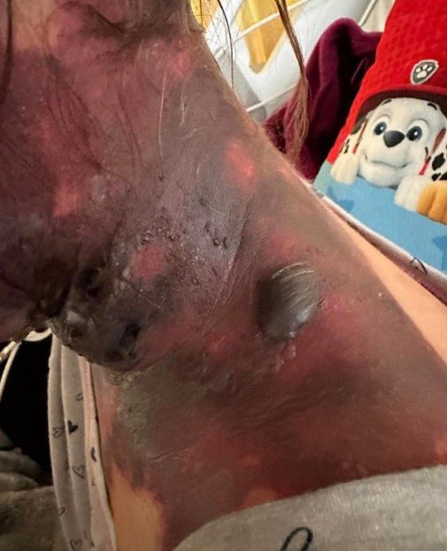 LeilaniDowding's tweet photo. These are the latest pics of Alexis (Lexi) Lorenze, shared by her father, Todd Lorenze… 

She should never ever have been forced to have had those vaccines. Especially all in 1 go.   I just hope she can heal
From this Pray 🙏🏽 https://t.co/ZzdctARcsL