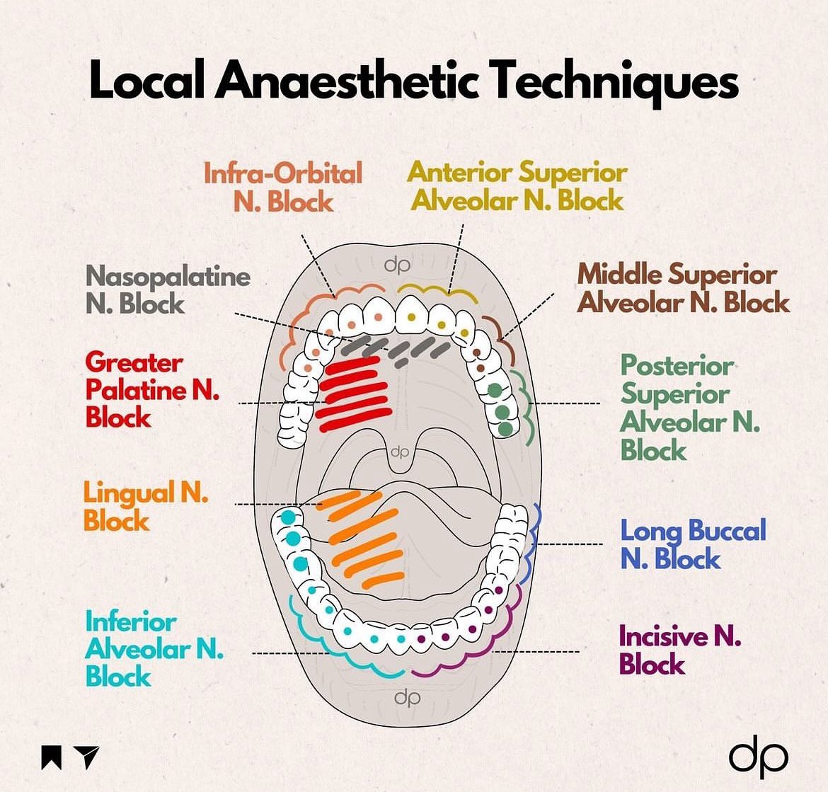 DiariesDent's tweet image. Local anesthesia techniques in one pic 📚