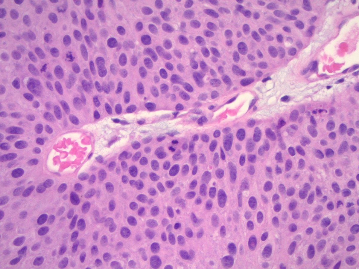 riham_katkhuda's tweet image. ALL are High grade papillary urothelial carcinoma, EXCEPT one Low grade, could you recognize it ?
#path2path #PathTwitter #GUpath #gupath