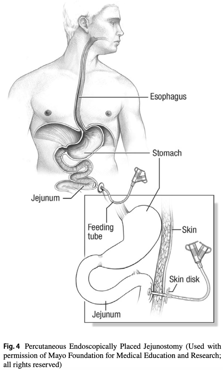 Vic_Tos19's tweet photo. Principios para la indicación en casos de Nutrición Enteral.

DOI: 10.1007/s11894-024-00934-8 https://t.co/ssGVdPkZI6