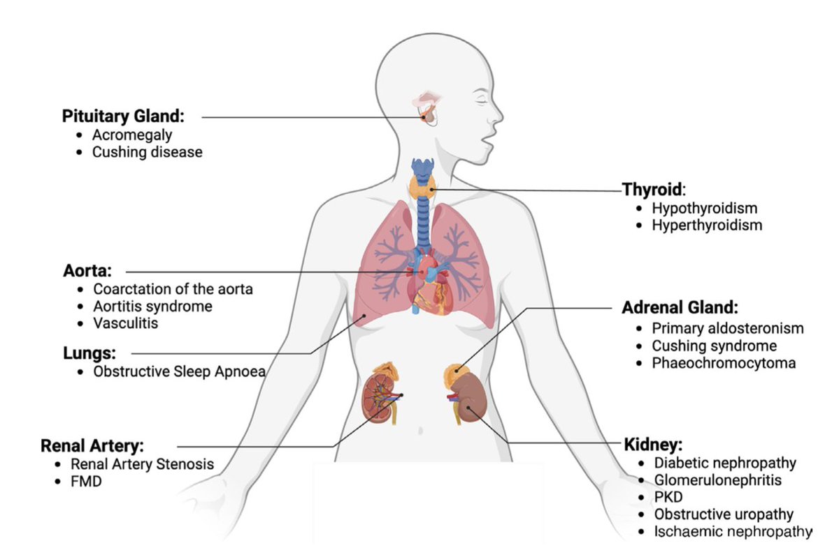 Well done to <a href="/ClaudiaZeee/">Claudia Zeicu</a> on her <a href="/PracticalNeurol/">Practical Neurology</a>  review discussing the causes of secondary hypertension in cerebrovascular disease - worth checking out for an overview of how to approach its investigation and management.

<a href="/CamStroke/">Cambridge Stroke</a>