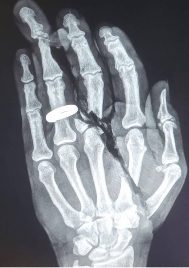 Farmers are wild because they will be like “I’m fine Doc, it’s just a little scrape, my wife made me come in,” and their X-Ray will look like this 

🤯