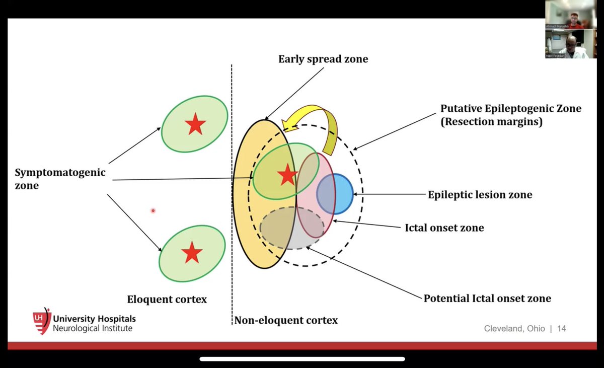 Neel Fotedar (@neelmed) on Twitter photo Our video with Ahmad Marashly of <a href="/HopkinsEpilepsy/">Johns Hopkins Epilepsy Center</a> discussing the concept of #EpileptogenicZone and #EpilepticNetworks has >200 views. Check it out <a href="/VuMedi/">VuMedi</a> #Epilepsy #EpilepsySurgery #SEEG #EEG #NeuroX #NeurologyRF <a href="/CwruEpilepsy/">Case Western Reserve Univ/UH Epilepsy Program</a>
vumedi.com/video/zones-vs… Our video with Ahmad Marashly of <a href="/HopkinsEpilepsy/">Johns Hopkins Epilepsy Center</a> discussing the concept of #EpileptogenicZone and #EpilepticNetworks has >200 views. Check it out <a href="/VuMedi/">VuMedi</a> #Epilepsy #EpilepsySurgery #SEEG #EEG #NeuroX #NeurologyRF <a href="/CwruEpilepsy/">Case Western Reserve Univ/UH Epilepsy Program</a>
vumedi.com/video/zones-vs…