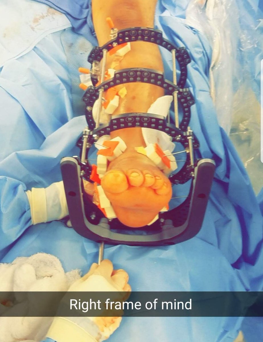 David H. Chafey MD FAAOS (@davidhcmd) on Twitter photo Case based discussions w/ THE @DrMarecek & Dr. Bernstein on Adding Ring Fixation to your Practice on 9/25!
(See link below for registration and schedule)
<a href="/jamesablairMD/">James A. Blair, MD, FAAOS, FACS</a>
<a href="/otaeducation/">OTA Online</a> <a href="/otatrauma/">OTA</a>
education.ota.org/products/addin… Case based discussions w/ THE @DrMarecek & Dr. Bernstein on Adding Ring Fixation to your Practice on 9/25!
(See link below for registration and schedule)
<a href="/jamesablairMD/">James A. Blair, MD, FAAOS, FACS</a>
<a href="/otaeducation/">OTA Online</a> <a href="/otatrauma/">OTA</a>
education.ota.org/products/addin…