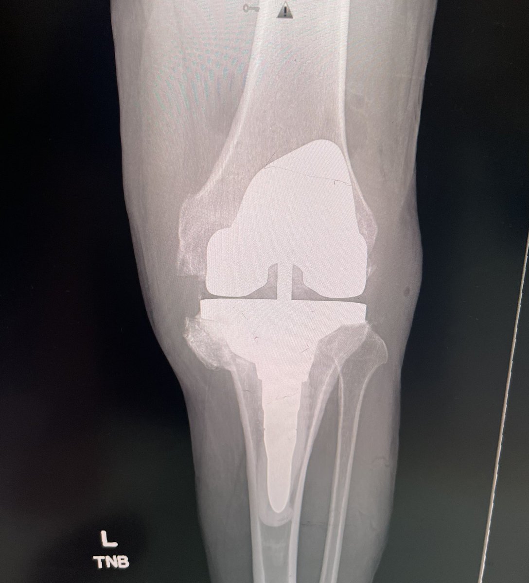 Huesoman7's tweet photo. @BrianChalmersMD @generalorthomd @jointdocShields Thanks for the replies all. Love the ortho twitter fellowship. Went with a primary femur, and asymmetric cone to get some biological fixation on the medial side after debriding a lot of fibrous junk. Needed a TS insert in the end for balancing but
MCL intact https://t.co/D7mhTP07UH