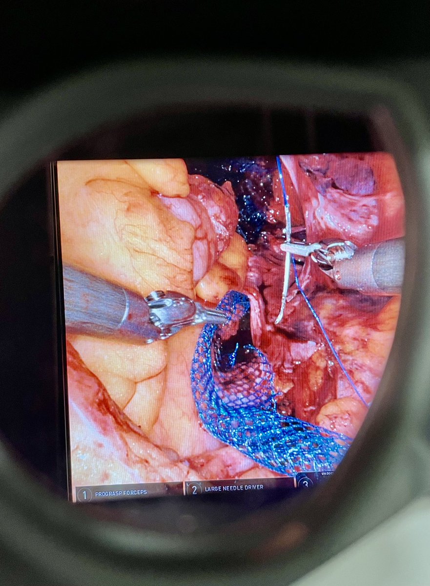 What a crazy day operating in HK’s Queen Mary Hosp. 🙏 to <a href="/WayneLam_Urol/">Wayne Lam</a> and #DrAdaNg <a href="/Thomaswong1023/">Thomas Wong</a>. Including this completely everted bladder from urethra, other robotic/transvag recon cases. Productive. interesting for all. <a href="/USANZUrology/">USANZ</a> <a href="/sufuorg/">SUFU</a> <a href="/USANZUrology/">USANZ</a> <a href="/icsoffice/">ICS</a>