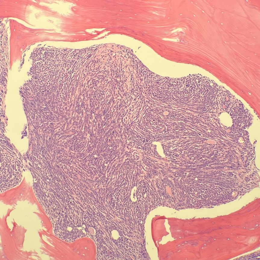 megothelioma's tweet image. Check out how the fibrosis in this marrow forces the cellularity into a single file lines, giving a swirly streaming look. Kinda like a fingerprint. It's not usually this striking 😍

#hemepath #hematology
