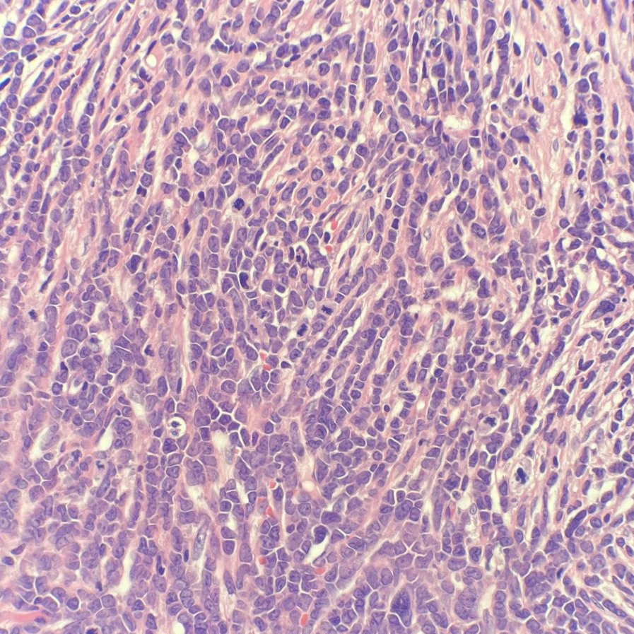 megothelioma's tweet image. Check out how the fibrosis in this marrow forces the cellularity into a single file lines, giving a swirly streaming look. Kinda like a fingerprint. It's not usually this striking 😍

#hemepath #hematology