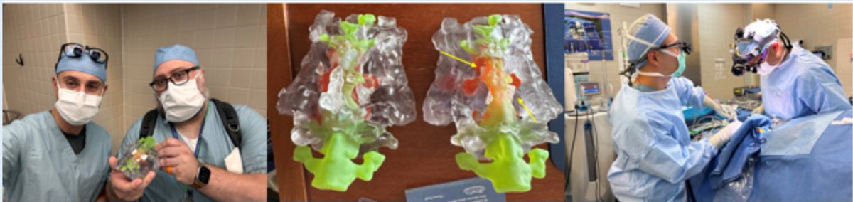 Humza Nusrat, Ph.D. (@hznus) on Twitter photo An exciting achievement at <a href="/HenryFordHealth/">Henry Ford Health</a> — the world’s first Cs-131 Gamma Tile spine implant! Excellent example of collaboration between radonc, physics, neurosurgery, and design teams.
<a href="/tonydoemer/">Anthony Doemer</a> <a href="/SalimSiddiquiMD/">Salim Siddiqui MD PhD</a> An exciting achievement at <a href="/HenryFordHealth/">Henry Ford Health</a> — the world’s first Cs-131 Gamma Tile spine implant! Excellent example of collaboration between radonc, physics, neurosurgery, and design teams.
<a href="/tonydoemer/">Anthony Doemer</a> <a href="/SalimSiddiquiMD/">Salim Siddiqui MD PhD</a>