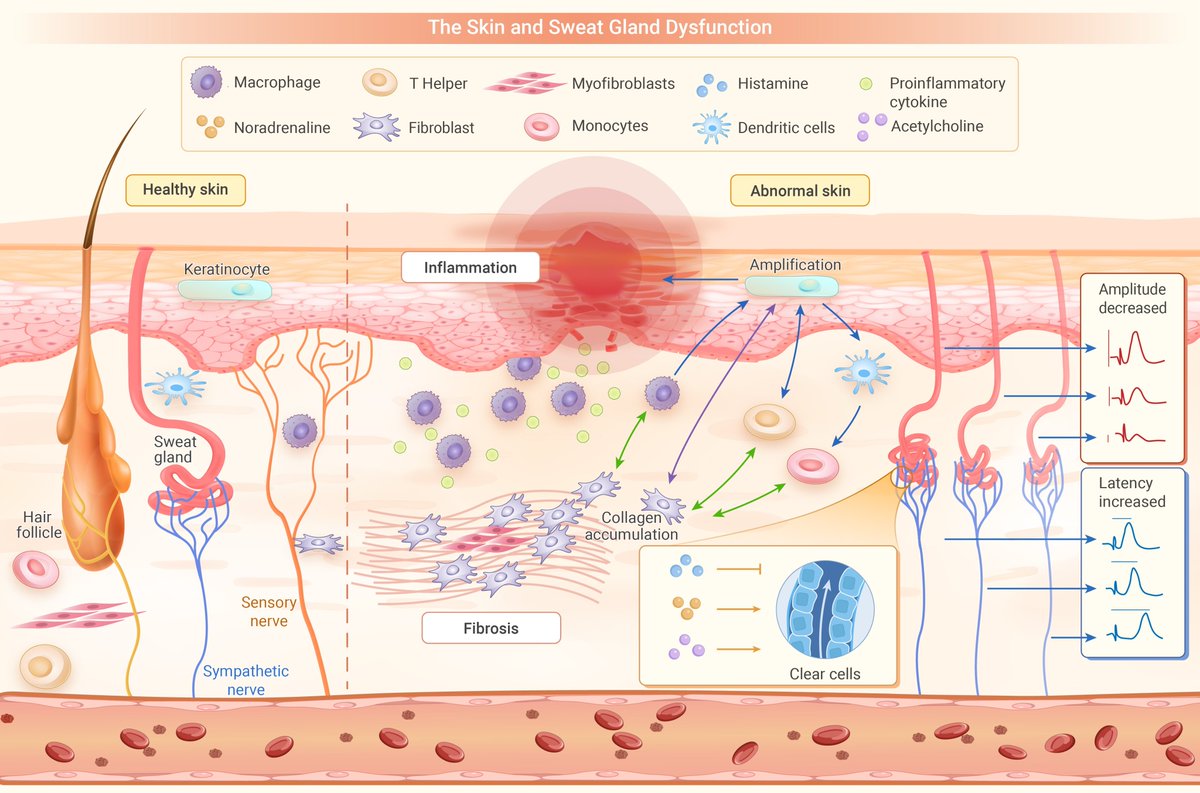The_InnovationJ's tweet image. This article reviews the physiological fundamentals, acquisition, and analysis of EDA signals, and evaluates its diagnostic and therapeutic value in dermatosis. Read  more @InnovationLife 
the-innovation.org/article/doi/10…
#LifeSciences #research #skindisease #Health