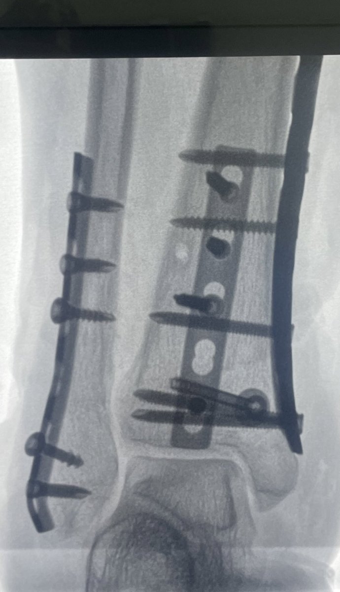 edisonpuebla765's tweet photo. La fractura de pilón tibial es la que afecta la porción más distal de la tibia por un mecanismo de carga axial generalmente producido por caída de altura, comparto un caso resuelto con osteosintesis más aporte de auto injerto de esponjosa tomado de la tibia proximal. https://t.co/8gDVymHnim