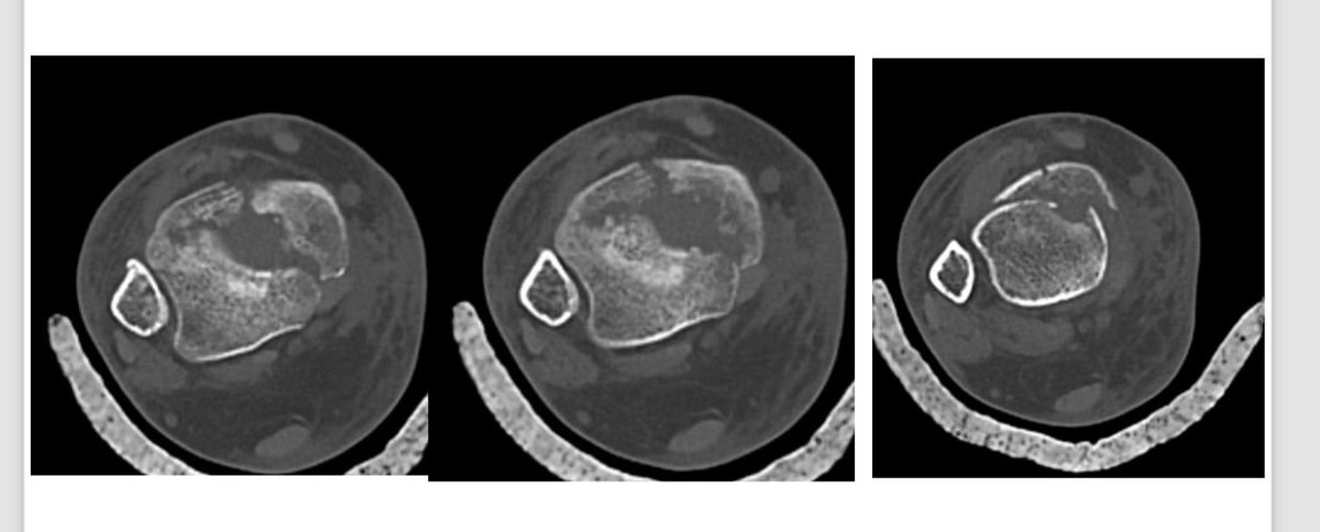 edisonpuebla765's tweet photo. La fractura de pilón tibial es la que afecta la porción más distal de la tibia por un mecanismo de carga axial generalmente producido por caída de altura, comparto un caso resuelto con osteosintesis más aporte de auto injerto de esponjosa tomado de la tibia proximal. https://t.co/8gDVymHnim