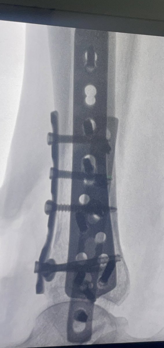 edisonpuebla765's tweet photo. La fractura de pilón tibial es la que afecta la porción más distal de la tibia por un mecanismo de carga axial generalmente producido por caída de altura, comparto un caso resuelto con osteosintesis más aporte de auto injerto de esponjosa tomado de la tibia proximal. https://t.co/8gDVymHnim