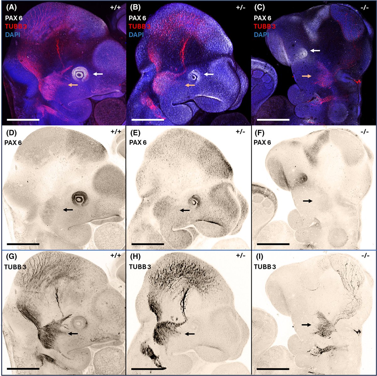 DevelopmentalDynamic (@developmentaldy) on Twitter photo #Neural tube defects caused by #genetic or #environmental factors affect 300,000 babies per year worldwide. Learn how #Fuz is required for #neuroepithelial integrity, and persistent loss of neuroepithelial stiffness precedes #exencephaly. doi.org/10.1002/dvdy.7… <a href="/carlo_donato/">Donato, PhD 🚩</a> #Neural tube defects caused by #genetic or #environmental factors affect 300,000 babies per year worldwide. Learn how #Fuz is required for #neuroepithelial integrity, and persistent loss of neuroepithelial stiffness precedes #exencephaly. doi.org/10.1002/dvdy.7… <a href="/carlo_donato/">Donato, PhD 🚩</a>