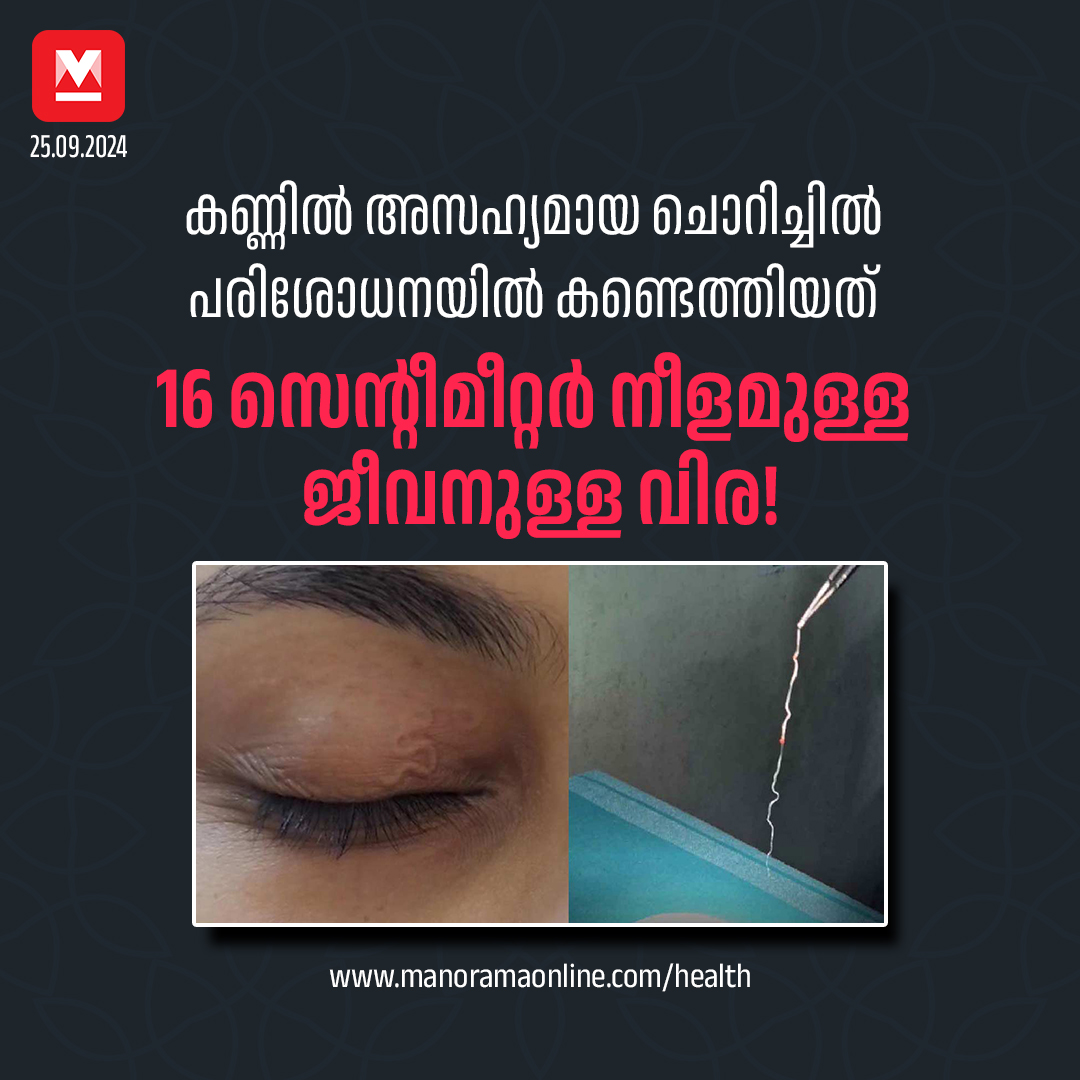 manoramaonline's tweet photo. പല തവണ ചികിത്സ തേടിയെങ്കിലും കാരണം കണ്ടെത്താൻ കഴിഞ്ഞിരുന്നില്ല. പല മരുന്നുകളും പരീക്ഷിച്ചു, പക്ഷേ ചൊറിച്ചിലിന് കുറവുണ്ടായില്ല...#EyeWorm #HealthNews #eyesonyoukimsoohyun
Read more on : https://t.co/dcrdlRhHnK https://t.co/O3u6D2beuE