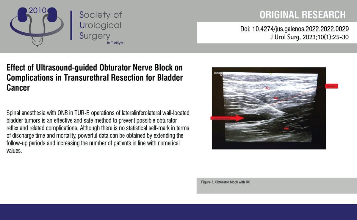 JUsurgery's tweet photo. Effect of Ultrasound-guided Obturator Nerve Block on Complicationsin Transurethral Resection for Bladder Cancer
 
You can see the free full text of the research by Hülya Topçu et al.
 
Link : https://t.co/PmwckDVGRy

#Cystoscopic #surgery #complications #obturator #nerve https://t.co/R8yVUxi87W