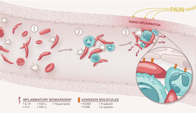 AB_drmd's tweet photo. تخيل مريض عنده Sickle Cell Anemia (فقر الدم المنجلي) يجيك يصرخ من الألم، تعبان مرة، ويمسكك بقوة ويقول: "يا دكتور، بولي صار لونه أحمر غامق أو أسود في آخر كم ساعة!"
أول ما تسمع هالكلام، أنوار الإنذار لازم تشتغل في راسك، ليش؟ لأنه غالبًا يعاني من Vaso-occlusive Crisis (أزمة انسداد الأوعية) وأنت لازم تكون سريع وتعرف تتصرف!

ايش اللي يصير في Sickle Cell Anemia؟
- ال��لية الحمراء الطبيعية شكلها زي الدونات أو القرص، مرنة وتتحرك بسهولة داخل الأوعية الدموية. لكن في Sickle Cell Anemia، الخلايا الحمراء تصير على شكل منجل (Sickle)، وهذي الخلايا تكون قاسية وتنسد في الأوعية الدموية. لما ينسد الوعاء الدموي، الدم ما يوصل للأنسجة بشكل كافي، فتبدأ الأنسجة تتألم ويصير فيها ischemia (نقص الأوكسجين).
- الألم اللي يحسه المريض هو بسبب انسداد الأوعية الدموية الصغيرة، وخلية المنجل تسبب أزمة، وهذا اللي نطلق عليه Vaso-occlusive Crisis. طبعًا هذا يسبب ألم قوي جدًا، خاصة في العظام والمفاصل.

الحين نجي للأعراض اللي جابها المريض:
1. الألم الحاد جدًا:
ليش الألم يكون شديد؟ لأن الأنسجة اللي ما وصلها الدم بسبب انسداد الخلايا المنجلية قاعدة تختنق، وحس الألم هنا مو شي بسيط. الألم هذا ممكن يجي فجأة ويستمر لساعات أو أيام.
2. الإر��اق الشديد:
لما الخلايا الحمراء تكون غير طبيعية وما تشتغل كويس، الأوكسجين اللي يوصل لأنسجة الجسم يكون قليل. يعني كل أعضاء الجسم متأثرة. والمريض يحس بتعب شديد لأنه ما فيه طاقة كافية لجسمه.
3. تغير لون البول للأحمر/الأسود:
هذي علامة مهمة جدًا، وهي hemoglobinuria أو hemolysis (تحلل خلايا الدم الحمراء). الخلايا المنجلية تكون هشة وتنكسر بسهولة، فلما تنكسر، الهيموغلوبين (البروتين اللي يحمل الأوكسجين) يطلع للدم، وينزل مع البول. وهذا يغير لون البول للأحمر أو الأسود.

ايش التشخيص؟
التشخيص هنا هو Vaso-occlusive Crisis مع Hemolytic Crisis، لأن المريض عنده الأعراض الكلاسيكية لـ Sickle Cell، مثل:
- ألم شديد جدًا.
- إرهاق.
- تغير لون البول.
الـ Vaso-occlusive Crisis هي اللي تسبب الألم الحاد، وHemolytic Crisis هي اللي تسبب تغيير لون البول بسبب تكسر الخلايا الحمراء.

وش تسوي معاه؟
1. تسكين الألم: الألم في هالحالة ممكن يكون جدًا شديد، فتعطيه Morphine أو أدوية قوية ثانية لتخفيف الألم.
2. ترطيب (Hydration): تعطيه سوائل وريدية عشان تخفف كثافة الدم وتساعد في تحريك الخلايا المنجلية عبر الأوعية.
3. أوكسجين: ممكن يحتاج أوكسجين إذا كانت مستويات الأوكسجين منخفضة.
4. نقل دم: إذا كانت الأزمة شديدة وتحليل الدم يوضح إن الـHb منخفض جدًا، ممكن يحتاج نقل دم.
5. التحكم في الـHemolysis: هذا عن طريق مراقبة وظائف الكلى والتأكد إن الهيموغلوبين المنكسر ما يسبب ضرر.

في النهاية:
Sickle Cell Anemia مرض خطير، والأزمات اللي تصير معاه مثل Vaso-occlusive Crisis وHemolytic Crisis ممكن تكون قاتلة إذا ما تعالجت بسرعة. فلو جاك مريض بهذي الأعراض، لازم تكون جاهز وتعرف إيش تسوي عشان تحميه وتخفف ألمه بسرعة.