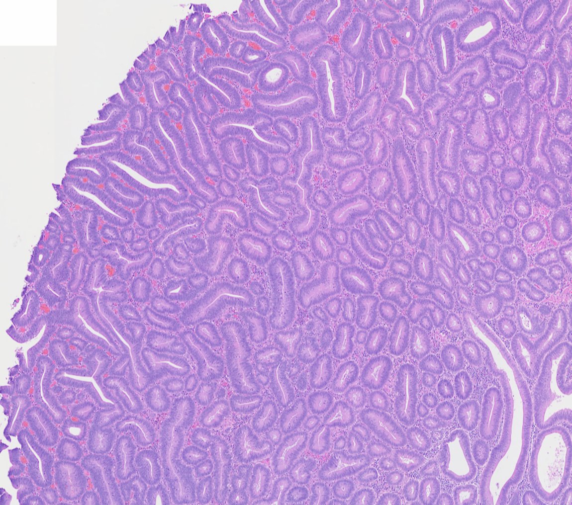DrSteinberg's tweet photo. Tell me if I invented a new word describing certain tubulovillous adenoma (TVA)  architecture.

"Coraliform"   

@corey_phd  @LizMontgomeryMD @Vik_deshpandeMD https://t.co/94xvBlSUJd