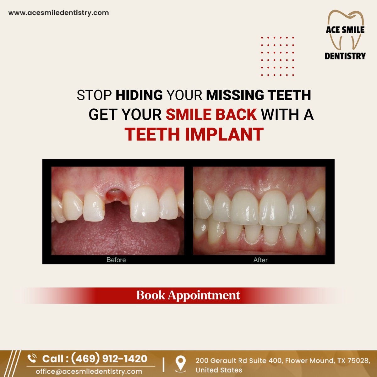 Acesmiledentist's tweet image. Stop hiding missing teeth! Ace Smile Dentistry offers advanced solutions like dental implants to restore your smile and confidence. Enjoy natural-looking, long-lasting results with our expert care. Book your consultation

#teethimplants #bestdentist #acesmiledentistry