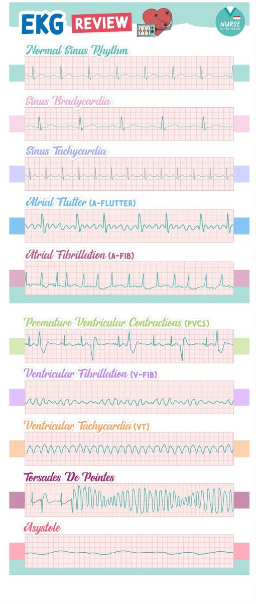 OGdukeneurosurg's tweet image. 10 EKGs to know