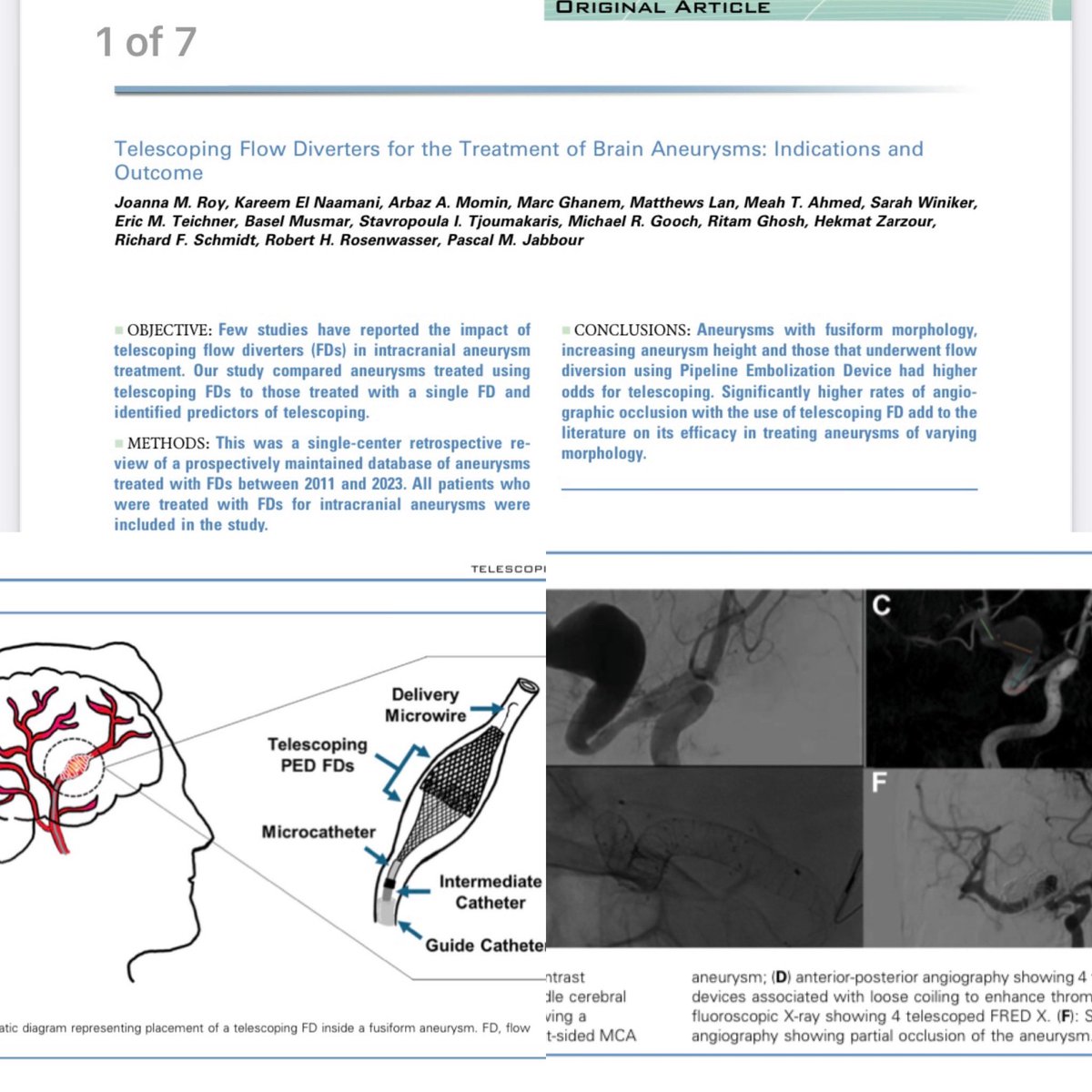 Sometimes one is not enough!
Predictors for using telescoping FDs were:
1-The choice of FD (PED)
2-Fusiform morphology 
3-Aneurysm height 
*The rate of ischemic and hemorrhagic stroke was higher 
*At final follow up the telescoping group had a higher rates of total persistent