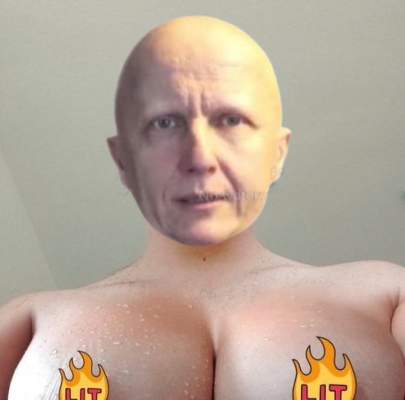 Rochita08c's tweet photo. Bueno, Sindrome de Cowden
Gracias a Paco Sanz no fallas
-El hombre de los 1000 tumores: muchos organos distintos y muchas lesiones en la piel
-Putero dominante: Gen PTEN AD
-Mentiroso: Tiene TETAS y ENDOMETRIO y los del colon NO MALIGNIZAN
-Cobarde: NO TIENE OVARIOS
A fijar🫵🏻 https://t.co/CGv0VKdTug