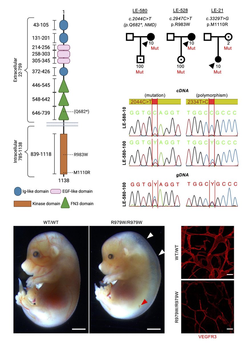 NAVBO (@vascularbiology) on Twitter photo #NAVBO Member Publication Alert
Loss-of-function mutations of the TIE1 receptor tyrosine kinase cause late-onset primary lymphedema
Dr. Kari Alitalo & Miikka Vikkula groups <a href="/jclinicalinvest/">Journal of Clinical Investigation</a> 2024 <a href="/Pasc_Brouillard/">Pascal Brouillard - UCLouvain</a> <a href="/MiikkaVikkula/">Miikka. Vikkula</a>
jci.org/articles/view/… #NAVBO Member Publication Alert
Loss-of-function mutations of the TIE1 receptor tyrosine kinase cause late-onset primary lymphedema
Dr. Kari Alitalo & Miikka Vikkula groups <a href="/jclinicalinvest/">Journal of Clinical Investigation</a> 2024 <a href="/Pasc_Brouillard/">Pascal Brouillard - UCLouvain</a> <a href="/MiikkaVikkula/">Miikka. Vikkula</a>
jci.org/articles/view/…