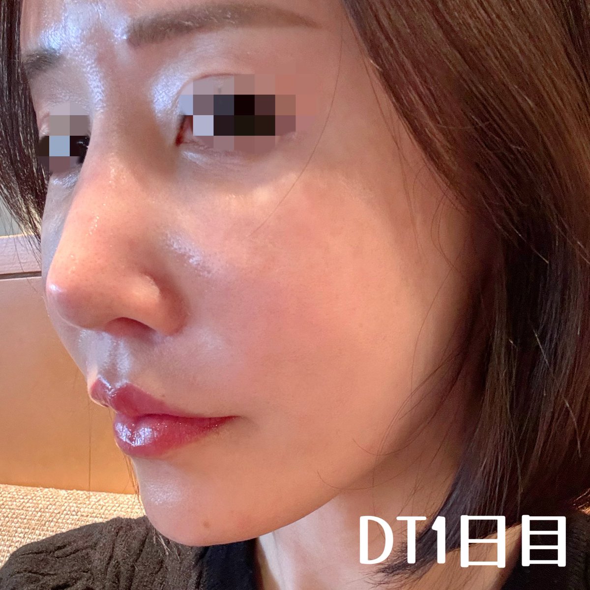 mimi___ooo33's tweet photo. 鼻尖上部をスッキリさせて忘れ鼻に？
fatXcore（脂肪溶解注射）💉

📍大阪市内の激推しクリニック
　注射1cc               9,000円
　ドクター手技料   3,800円　全て税込

⚠️注意点
☑︎鼻には打ってくれない先生多い
☑︎肋軟骨の鼻整形後でも影響なし
☑︎副作用は特になし
☑︎変化があまり出ない場合もある❗️
☑︎脂肪は少なからず誰でもある
（私はもともと骨感が強い鼻）
☑︎通常は2〜3回打つ

🍀施術当日
☑︎注入時、痛みあり
（リジュラン手打ちの半分くらいの痛さ）
☑︎注入後も2時間くらいズーンと鈍痛あり
☑︎針穴は4ヶ所で内出血なし
☑︎直後から腫れる
（ブスだけどマスクなしでも帰れた）
☑︎当日から洗顔OK
先生が「痛いよー」と言うから許可もらって施術前にロキソニン服用したら施術後の痛みはかなりマシだったよ✨あとは先生が上手👏

🍀DT1日目
☑︎たぶん腫れのピーク
☑︎目と目の間まで腫れあり
☑︎鼻筋が腫れで埋もれる感じあり
☑︎横顔が眉間にヒアル入れ過ぎた人みたい
☑︎内出血と痛みは無し
☑︎マスク生活
なんかアリクイみたいな顔。ギリマスクなしでスタバ入れるけど、人と話すならマスク必須。

もう少し経過見てからクリニック名は明かす予定💦とにかく今は鼻が太り過ぎてて何もわかりません笑
