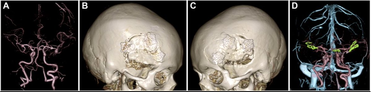 Neurosurgery Publications (@neurosurgerycns) on Twitter photo #NEUPrac The Second-Set Surgeries for Multiple Unruptured Aneurysms Do Not Increase Perioperative Complications bit.ly/3Bt27rp by Nounaka et al Nippon Medical School Hospital, Tokyo <a href="/jmascite/">Justin R. Mascitelli, MD, FAANS</a> <a href="/DKondziolkaCNS/">Douglas Kondziolka</a> <a href="/LKReedMD/">Laura K. Reed, MD</a> <a href="/george_maragkos/">George Maragkos, MD</a> <a href="/Zaazoue/">Mohamed Zaazoue</a> <a href="/urquiagajf_MD/">Jorge F. Urquiaga</a> <a href="/e_celano/">Emma Celano</a> #NEUPrac The Second-Set Surgeries for Multiple Unruptured Aneurysms Do Not Increase Perioperative Complications bit.ly/3Bt27rp by Nounaka et al Nippon Medical School Hospital, Tokyo <a href="/jmascite/">Justin R. Mascitelli, MD, FAANS</a> <a href="/DKondziolkaCNS/">Douglas Kondziolka</a> <a href="/LKReedMD/">Laura K. Reed, MD</a> <a href="/george_maragkos/">George Maragkos, MD</a> <a href="/Zaazoue/">Mohamed Zaazoue</a> <a href="/urquiagajf_MD/">Jorge F. Urquiaga</a> <a href="/e_celano/">Emma Celano</a>