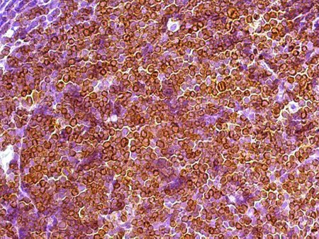 PenafortPaulo's tweet photo. B-cell lymphoblastic leukemia/lymphoma (B-ALL/LBL) manifesting in the mandible and medullary regions of a 10-year-old female. https://t.co/wxt1dry852 https://t.co/t6XnBcQ12H