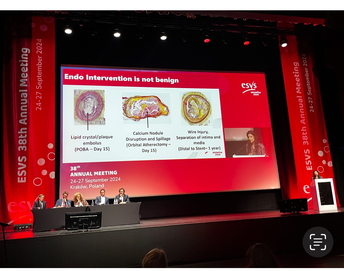 Trisha L. Roy MD PhD FACS (@trisharoymd) on Twitter photo Bypass after endo failure has higher amputation rates. But why? Check out our slide on distal lipid crystal embolization, wire injury and nodule disruption after endo treatment (all invisible on angiograms)! <a href="/BrighamVascular/">BWH Vascular Surgery</a> <a href="/BEST_CLI/">BEST-CLI Trial</a> <a href="/ESVSmembership/">ESVS</a> Bypass after endo failure has higher amputation rates. But why? Check out our slide on distal lipid crystal embolization, wire injury and nodule disruption after endo treatment (all invisible on angiograms)! <a href="/BrighamVascular/">BWH Vascular Surgery</a> <a href="/BEST_CLI/">BEST-CLI Trial</a> <a href="/ESVSmembership/">ESVS</a>