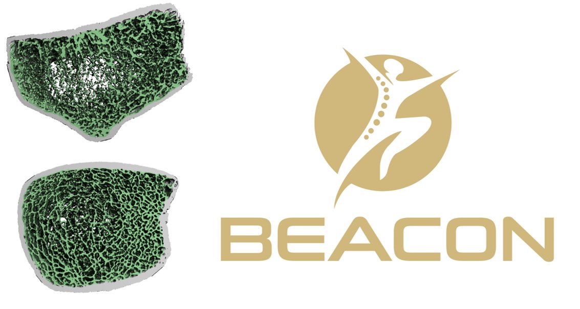 Wake Forest Biomedical Engineering (@wakebme) on Twitter photo 🚨#NewPub Alert!🚨
Design paper on the BEACON clinical trial 🦴 co-authored by our own <a href="/AshleyAWeaver/">Ashley A. Weaver, PhD</a> & Kristen Beavers alongside amazing teams from Wake Forest, <a href="/CUMedicalSchool/">CU School of Medicine</a>, <a href="/UCSF/">UC San Francisco</a>, & <a href="/EasternCoGrecc/">Eastern Colorado GRECC</a> !
Full article available now ⤵️
🔗sciencedirect.com/science/articl… <a href="/ElsevierNews/">Elsevier News</a> 🚨#NewPub Alert!🚨
Design paper on the BEACON clinical trial 🦴 co-authored by our own <a href="/AshleyAWeaver/">Ashley A. Weaver, PhD</a> & Kristen Beavers alongside amazing teams from Wake Forest, <a href="/CUMedicalSchool/">CU School of Medicine</a>, <a href="/UCSF/">UC San Francisco</a>, & <a href="/EasternCoGrecc/">Eastern Colorado GRECC</a> !
Full article available now ⤵️
🔗sciencedirect.com/science/articl… <a href="/ElsevierNews/">Elsevier News</a>