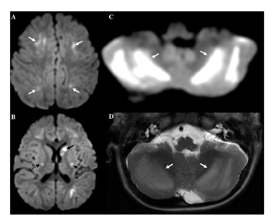 nirmalregency's tweet image. Next time we prescribe dextromethorphan hydrobromide cough syrups: Think DANCE not POUNCE. An eye popping case series.
ajnr.org/content/early/…