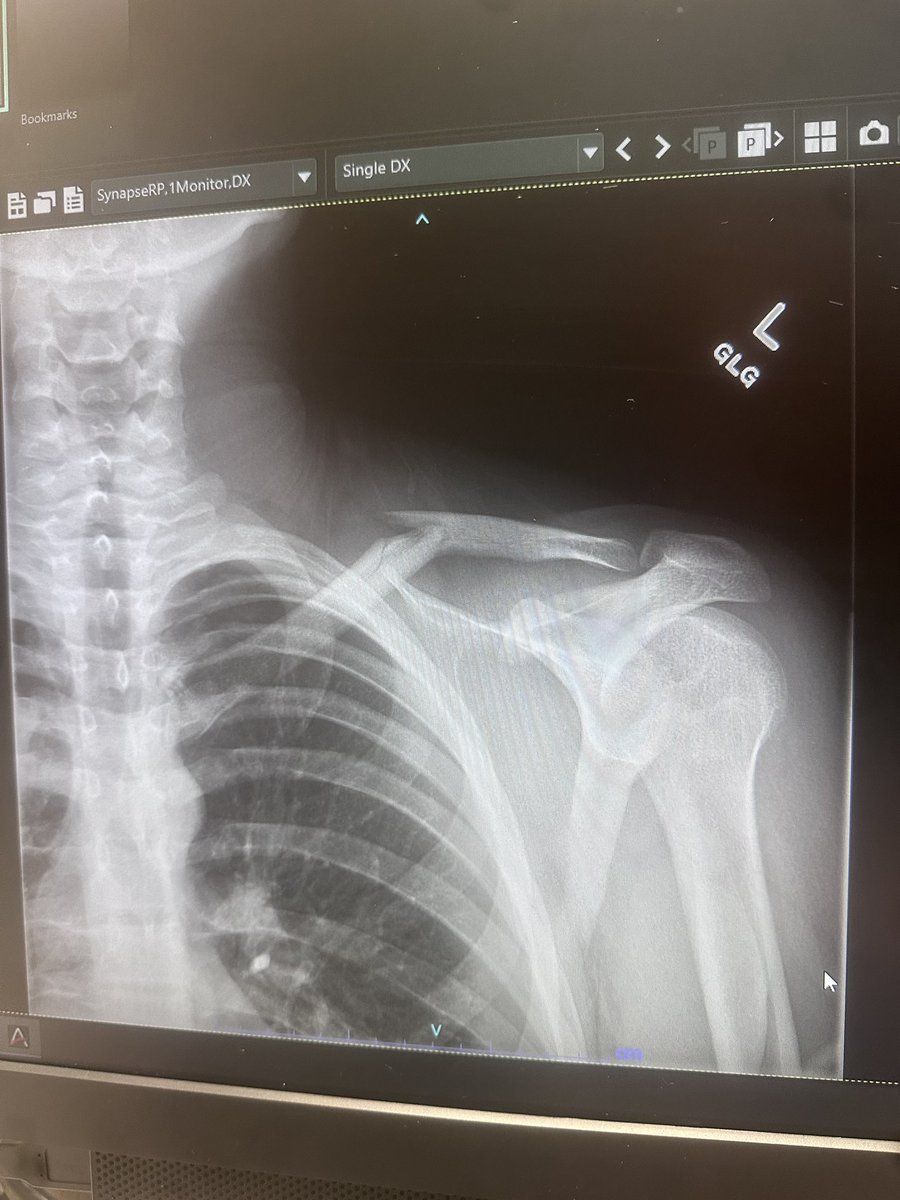 Nathaniel2620's tweet photo. Haven’t rly got the chance to post about it,but unfortunately I broke my collarbone in week 2 but shooting for a speedy recovery and being back for playoffs‼️🏈 https://t.co/4GOPvkpyxU