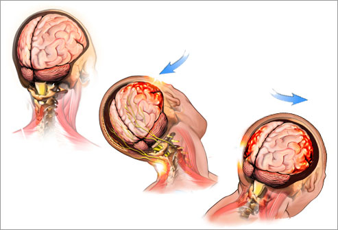 SOAR Canada (@canadasoar) on Twitter photo Most survivors of physical I#IPV may suffer a concussion from blows to the face, head, and neck. Learn to recognize and respond by taking the <a href="/cattonline/">cattonline</a> course for Women's Support Workers at cattonline.com/course/concuss… #concussionbc #concussionawarenessweek #concussioned Most survivors of physical I#IPV may suffer a concussion from blows to the face, head, and neck. Learn to recognize and respond by taking the <a href="/cattonline/">cattonline</a> course for Women's Support Workers at cattonline.com/course/concuss… #concussionbc #concussionawarenessweek #concussioned