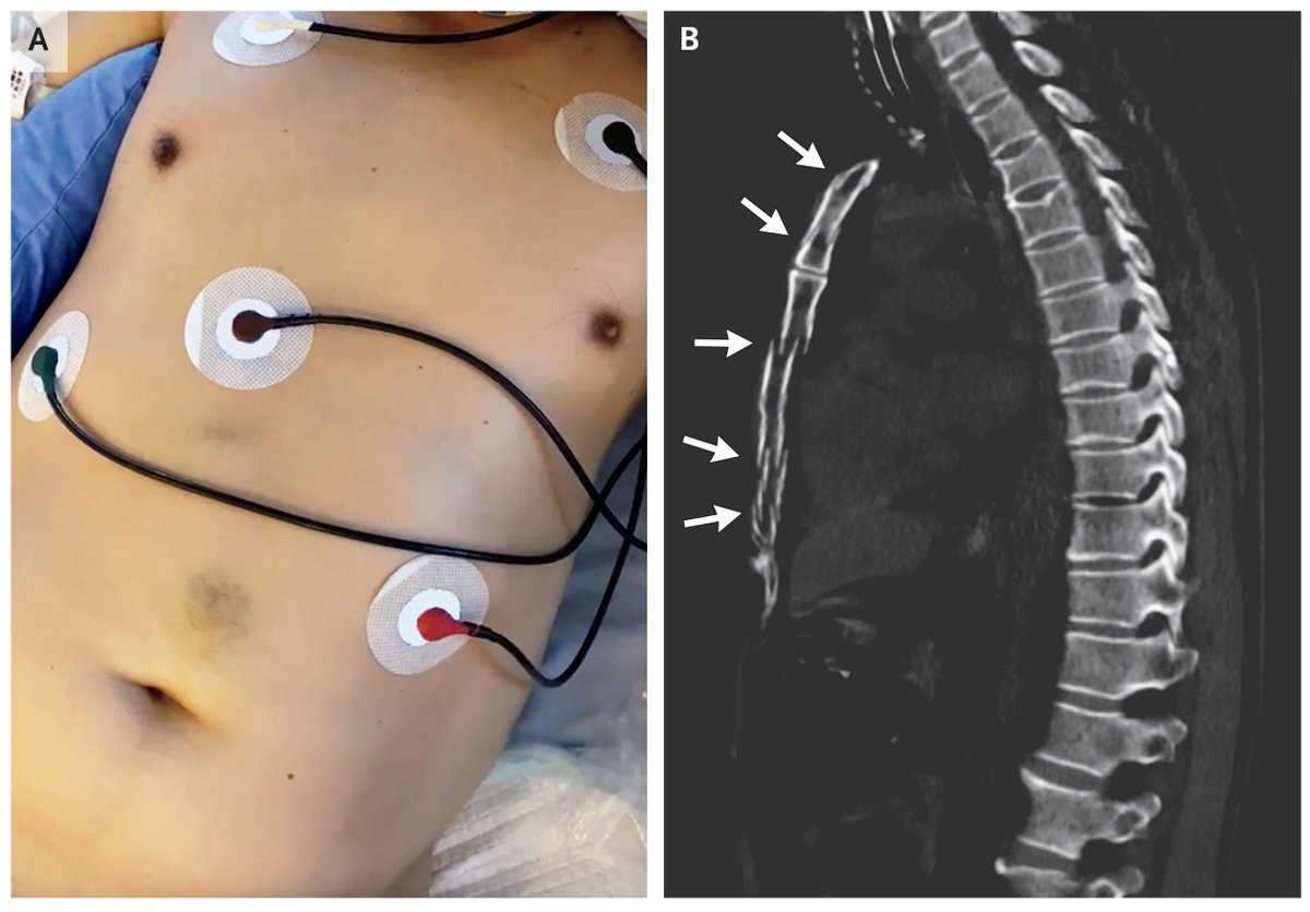 NEJM's tweet photo. Images in Clinical Medicine: Flail Chest https://t.co/XMY588gUjG 

#Trauma https://t.co/N1unFcU2rj