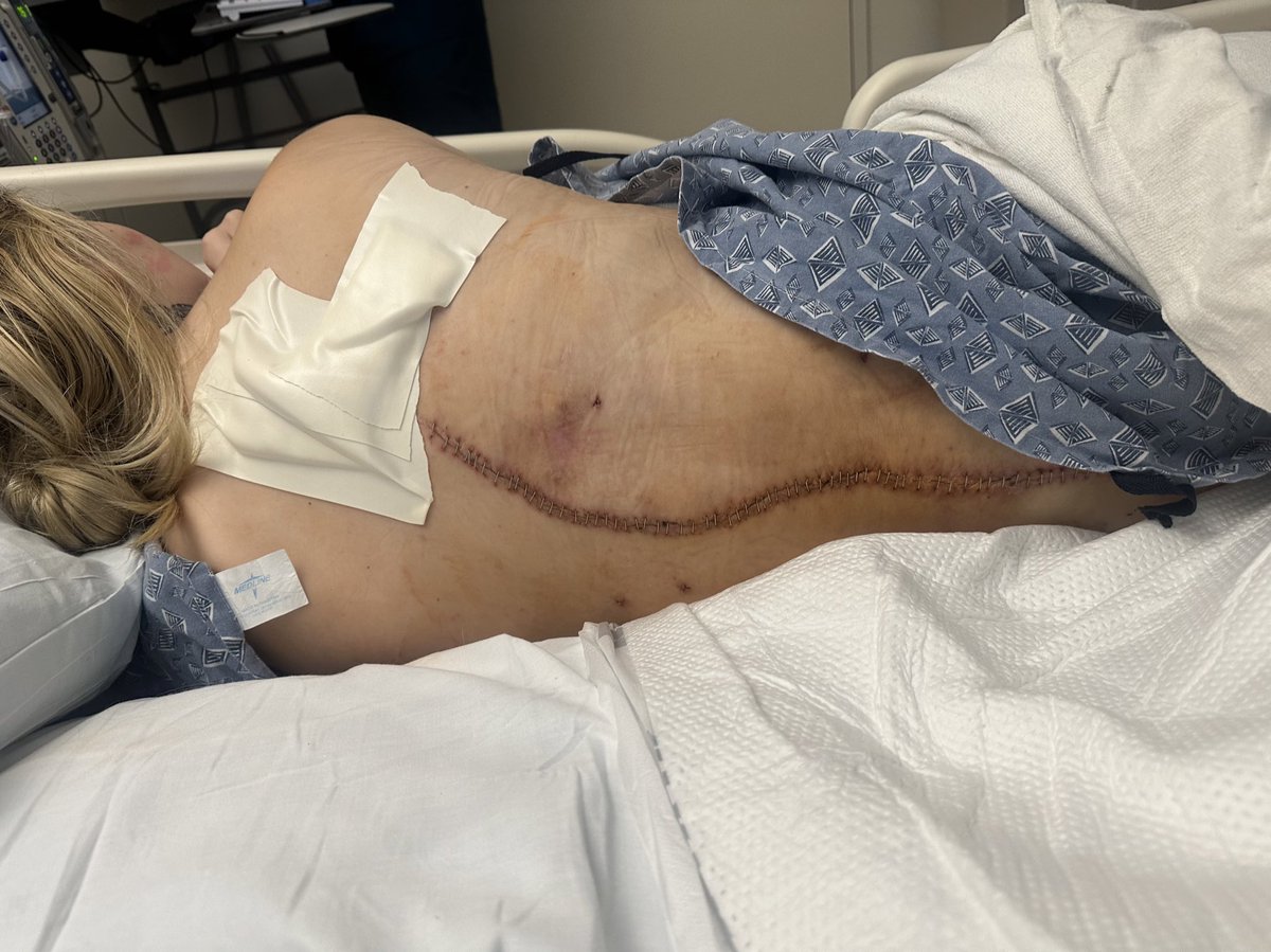 notkarleerose's tweet photo. i just had my 10th spine surgery in the span of 3 1/2 years since my car accident. all of them being related to becoming paralyzed. i normally don’t share things like this and like to stay as positive as i can be. reaching 10 spine surgeries due to spinal curvature, blood infections, bone infections, and spinal fluid leaks made me realize how lucky i am to be alive… but also how tired i am. it’s a constant battle between appreciating the life i have but grieving my old one. it’s tiring being in the hospital constantly and never knowing what’s going to happen next. spinal cord injuries are not easy and re learning how to navigate my life after each surgery is even harder. i’m so grateful for the support i have but want to bring awareness to the challenges people with disabilities face. it’s not “just sitting in a chair” there’s so much more to it.