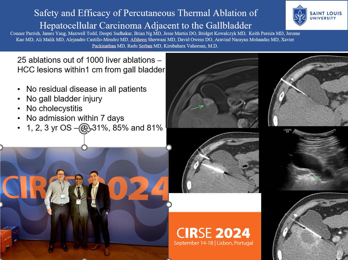 Kirubahara Vaheesan MD (@vaheesanir) on Twitter photo Curative intent 25 Ablations out of 1000 ablations #HCC lesions within 1 cm from gall bladder. #CIRSE2024
No residual disease (100%)
No GB injury
No cholecystitis
No admission for 7 days. <a href="/SLU_VIR/">SLU Vascular Interventional Radiology</a> <a href="/SIRspecialists/">Society of Interventional Radiology</a> <a href="/SSMHealthSTL/">SSM Health St. Louis</a>
<a href="/keithppereira/">Keith Pereira MD, #VIrad</a>
<a href="/DavidOw94096280/">David Owens</a>
<a href="/cirsesociety/">CIRSE</a> Curative intent 25 Ablations out of 1000 ablations #HCC lesions within 1 cm from gall bladder. #CIRSE2024
No residual disease (100%)
No GB injury
No cholecystitis
No admission for 7 days. <a href="/SLU_VIR/">SLU Vascular Interventional Radiology</a> <a href="/SIRspecialists/">Society of Interventional Radiology</a> <a href="/SSMHealthSTL/">SSM Health St. Louis</a>
<a href="/keithppereira/">Keith Pereira MD, #VIrad</a>
<a href="/DavidOw94096280/">David Owens</a>
<a href="/cirsesociety/">CIRSE</a>