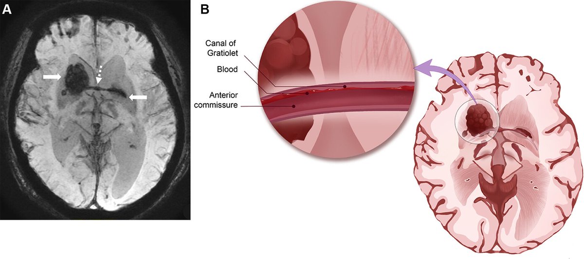 Gratiolet canal

Louis Pierre Gratiolet (1815-1850) 
French anatomist

Anterior commissure tube
&gt; thin layer grey matter circumferentially covers white matter fibers of anterior commissure

*allows a route for basal ganglia hemorrhage to track to the contralateral side