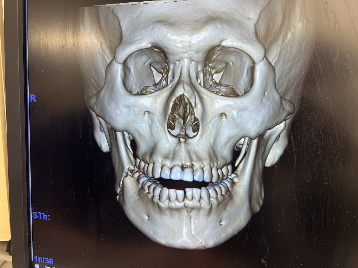 顎が砕けましたね
チャンピオン流石です