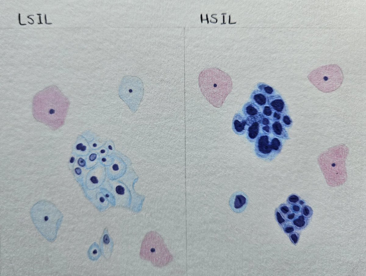 LSIL vs. HSIL Cytology

•↑ N/C ratio in HSIL
•More pronounced nuclear abnormalities (hyperchromasia and irregular nuclear contours) in HSIL
•Smaller cell size in HSIL
•Perinuclear halo in LSIL

#Pathology #PathTwitter #Match2025 #PathMatch2025