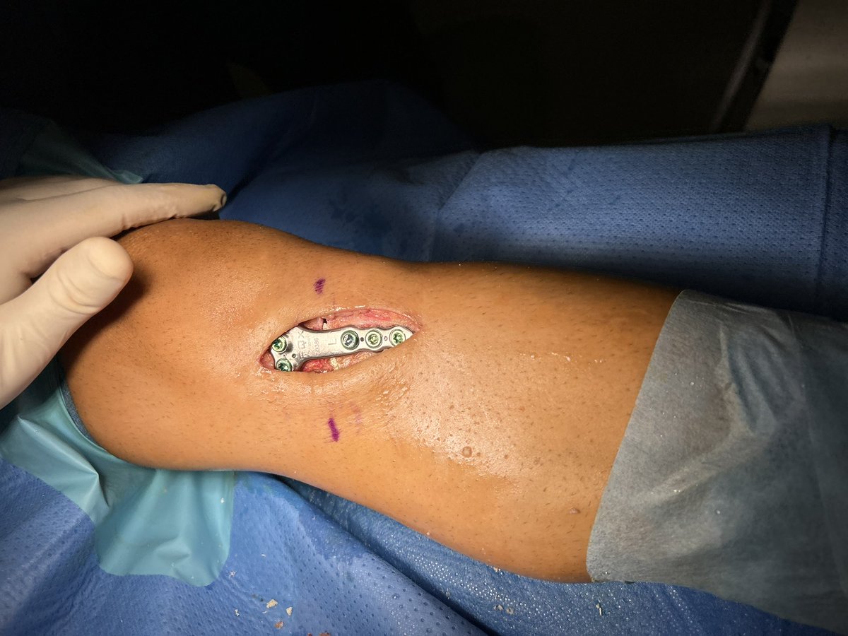 PlanificacionQx's tweet photo. Osteotomía valguizante tibial realizada por los Drs. @J_Hdez_Intra y @josearchidonat2

Planificación quirúrgica, fabricación de plantilla de corte a medida y placa a medida con cuña PQx VarVal fabricados en 24 horas. 

Pines de la guía planificados para garantizar la corrección https://t.co/XNs4j1BKia