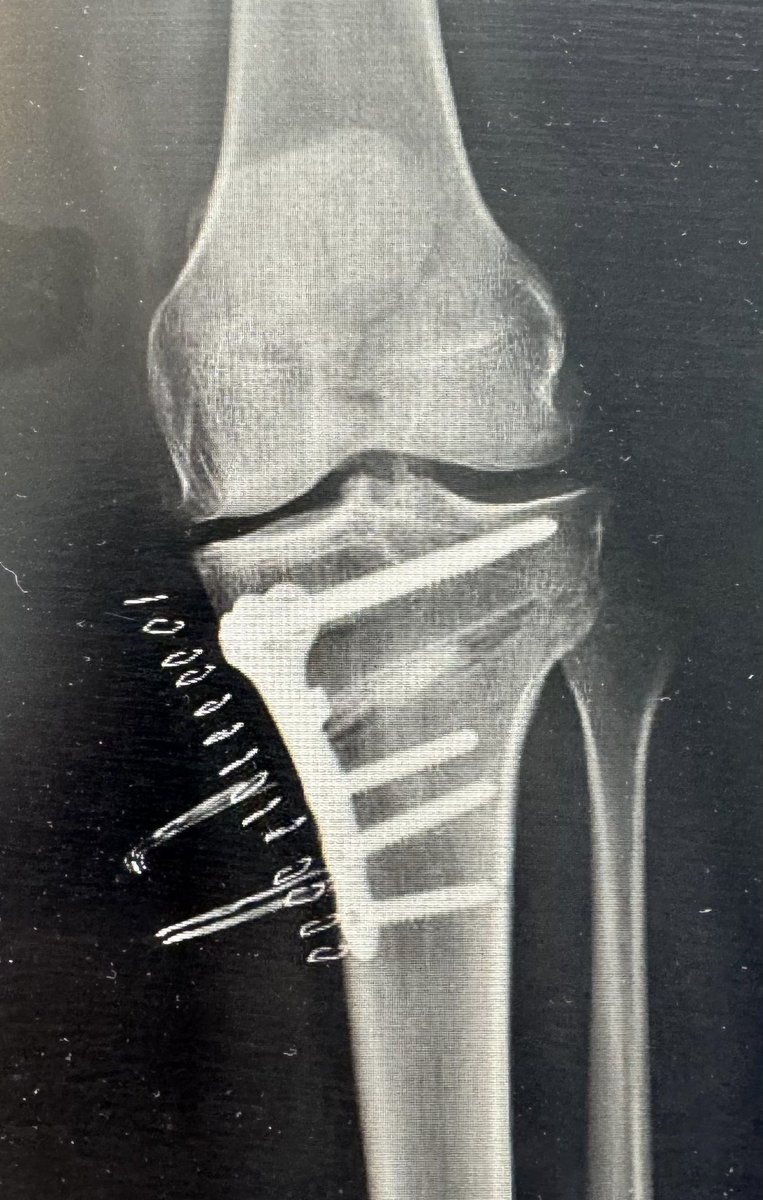 Osteotomía valguizante tibial realizada por los Drs. <a href="/J_Hdez_Intra/">Javier Hernández</a> y <a href="/josearchidonat2/">josearchidonatraumatologo</a>

Planificación quirúrgica, fabricación de plantilla de corte a medida y placa a medida con cuña PQx VarVal fabricados en 24 horas. 

Pines de la guía planificados para garantizar la corrección